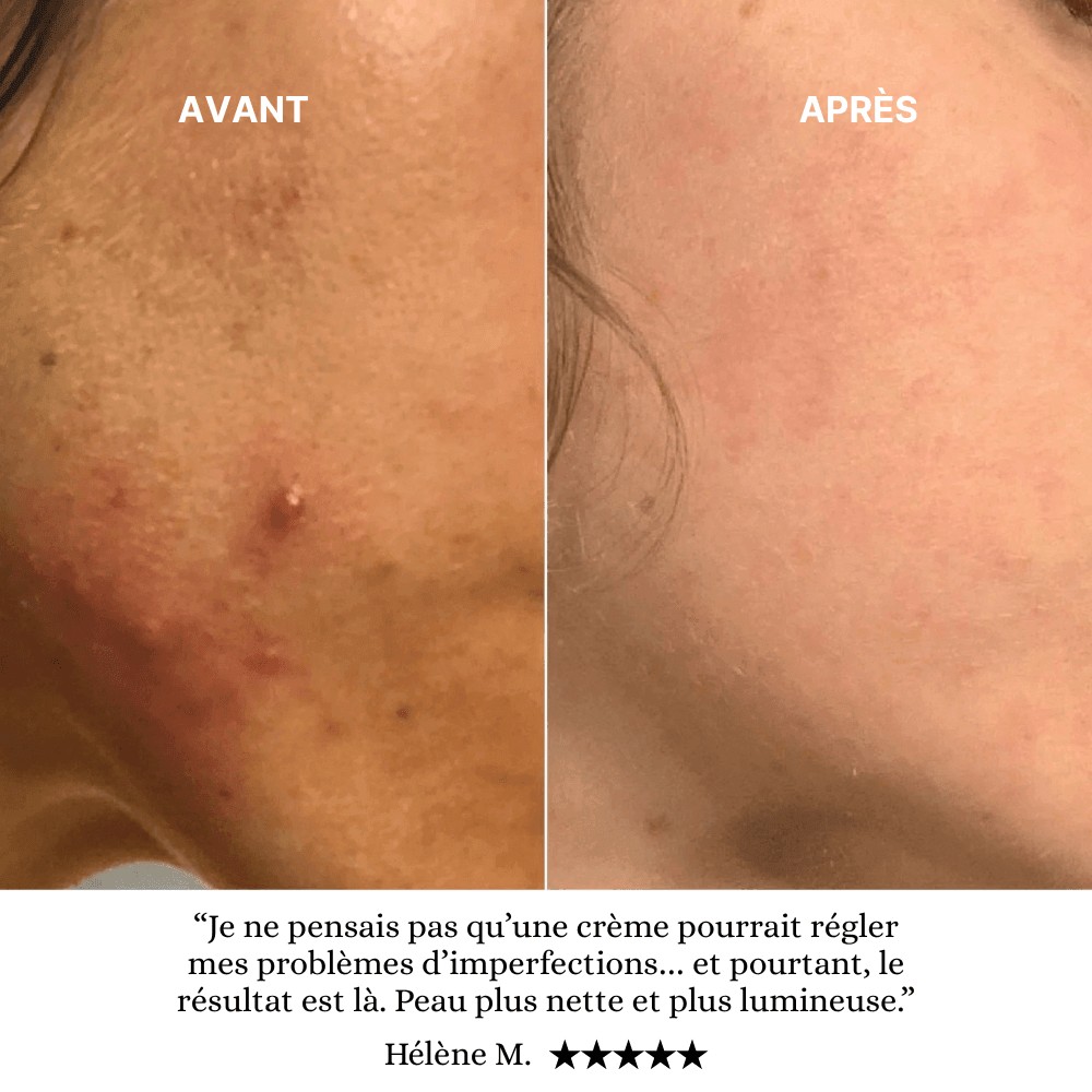Coffret Soin Anti Acné Complet