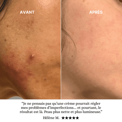 Coffret Soin Anti Acné Complet